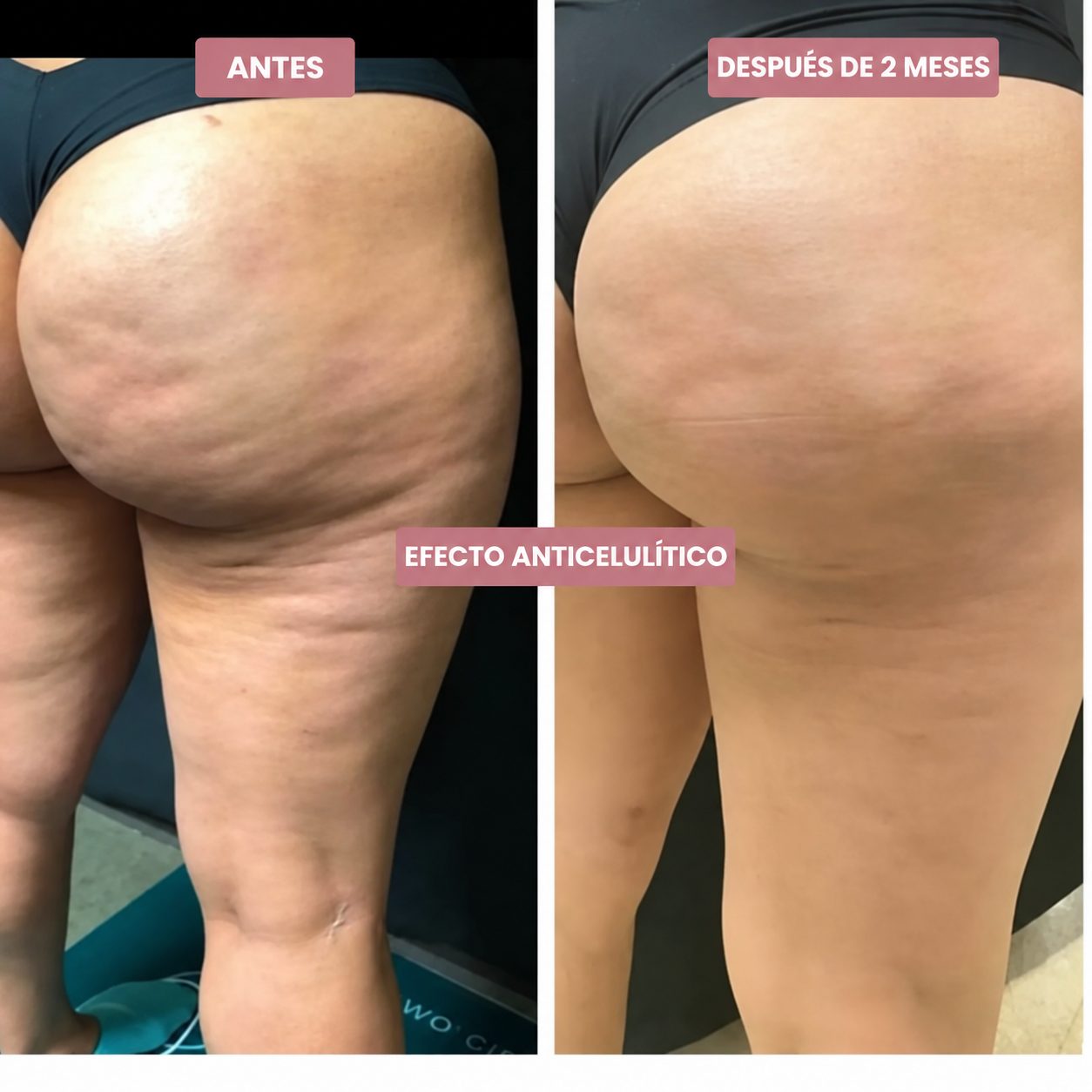 Antes y después de 2 meses: efecto anticelulítico